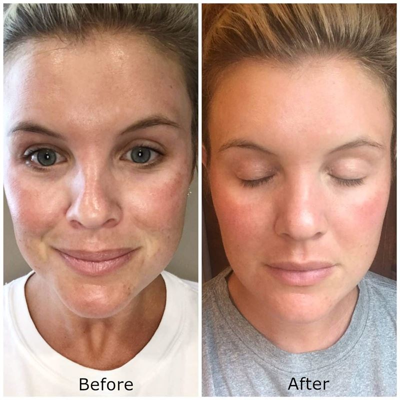 Dermaroller 540 needles with Titanium needles 0.5mm for the face - | Fashiongirl