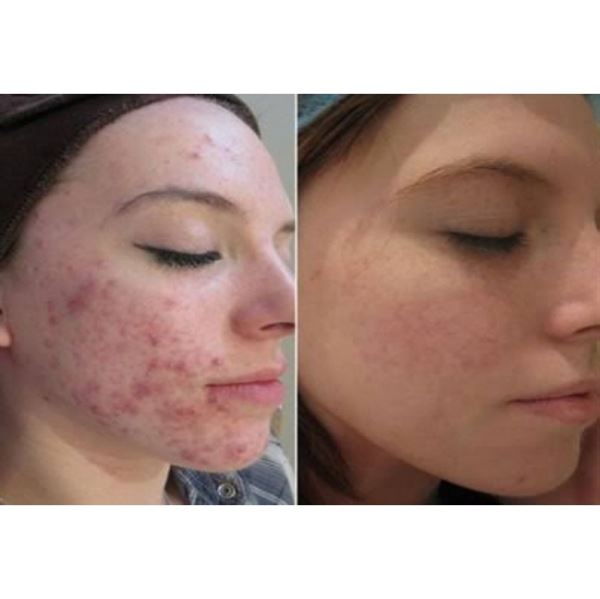 Dermaroller 540 needles with Titanium needles 0.5mm for the face - | Fashiongirl