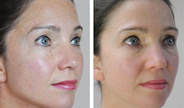 UNIQ Titanium Dermaroller 540 needles 0.25 mm. for the face - | Fashiongirl